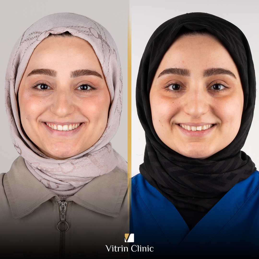 Invisalign